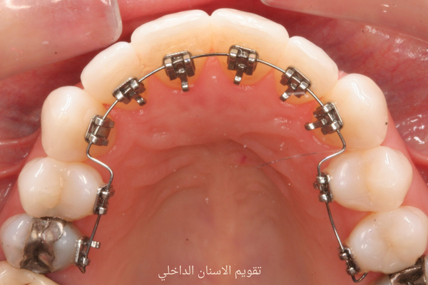 كيف يعمل تقويم الأسنان الموجود خلف الأسنان