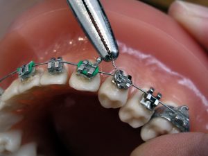 اكتشف طريقة تركيب تقويم الاسنان وما هو السن المناسب له؟