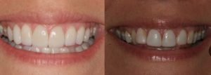 تعرف على تأثير عدسات الأسنان قبل وبعد واحصل على تحول مذهل في ابتسامتك
