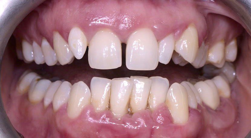 علاج فلجة الاسنان بدون تقويم