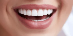 ابتسامة النجوم بين يديك: عمل فينير للأسنان