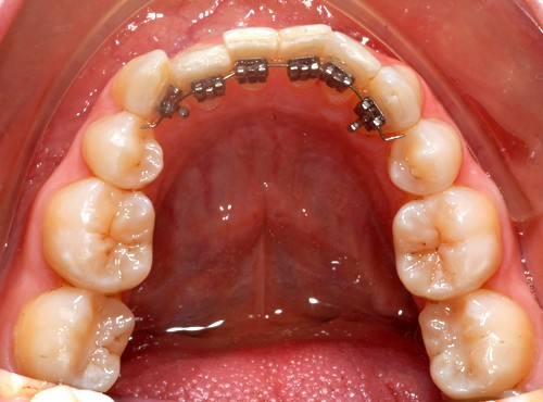 عيوب تقويم الأسنان الداخلي
