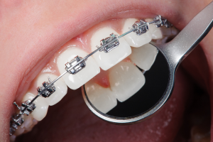 How long do front teeth braces last? When will its results appear?