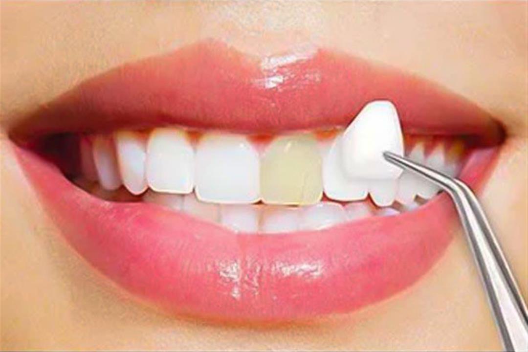 كيفية العناية بالأسنان بعد تركيب الفينير