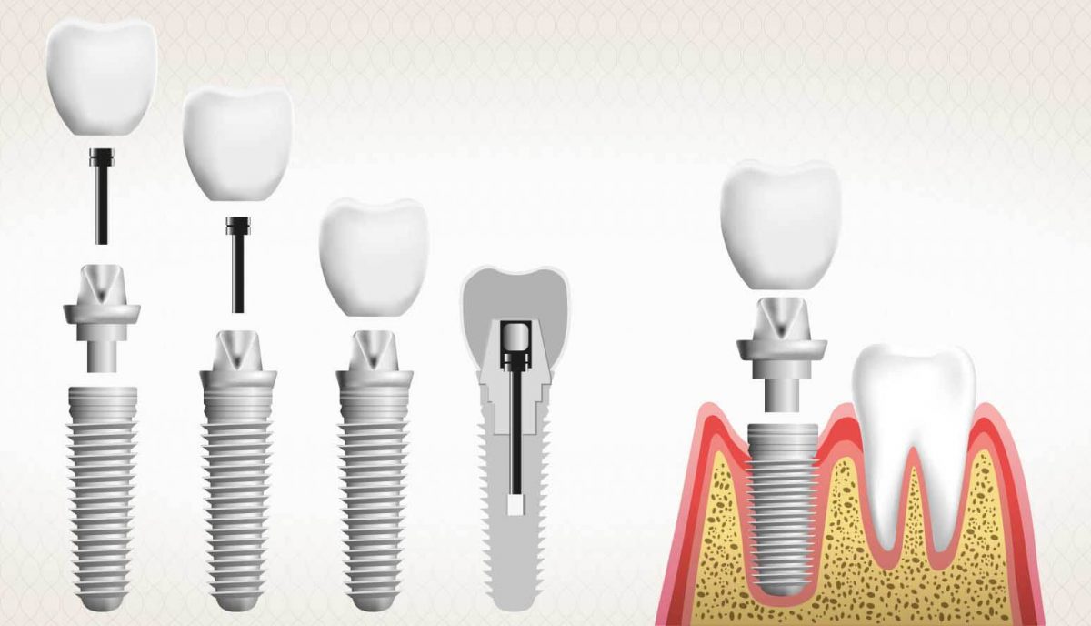 ما هي خطوات زراعة الأسنان ؟