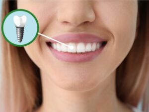 ما هي مشاكل تركيب الاسنان؟ وما النصائح التي يجب اتباعها لتقليلها؟