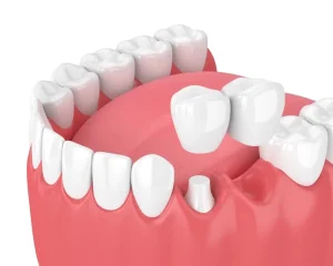 اكتشف الحلول المثالية لمعالجة مشاكل جسور الأسنان وأفضل المراكز المتخصصة