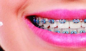 معلومات عن تقويم الأسنان وما هي اقل مدة لتركيبه؟