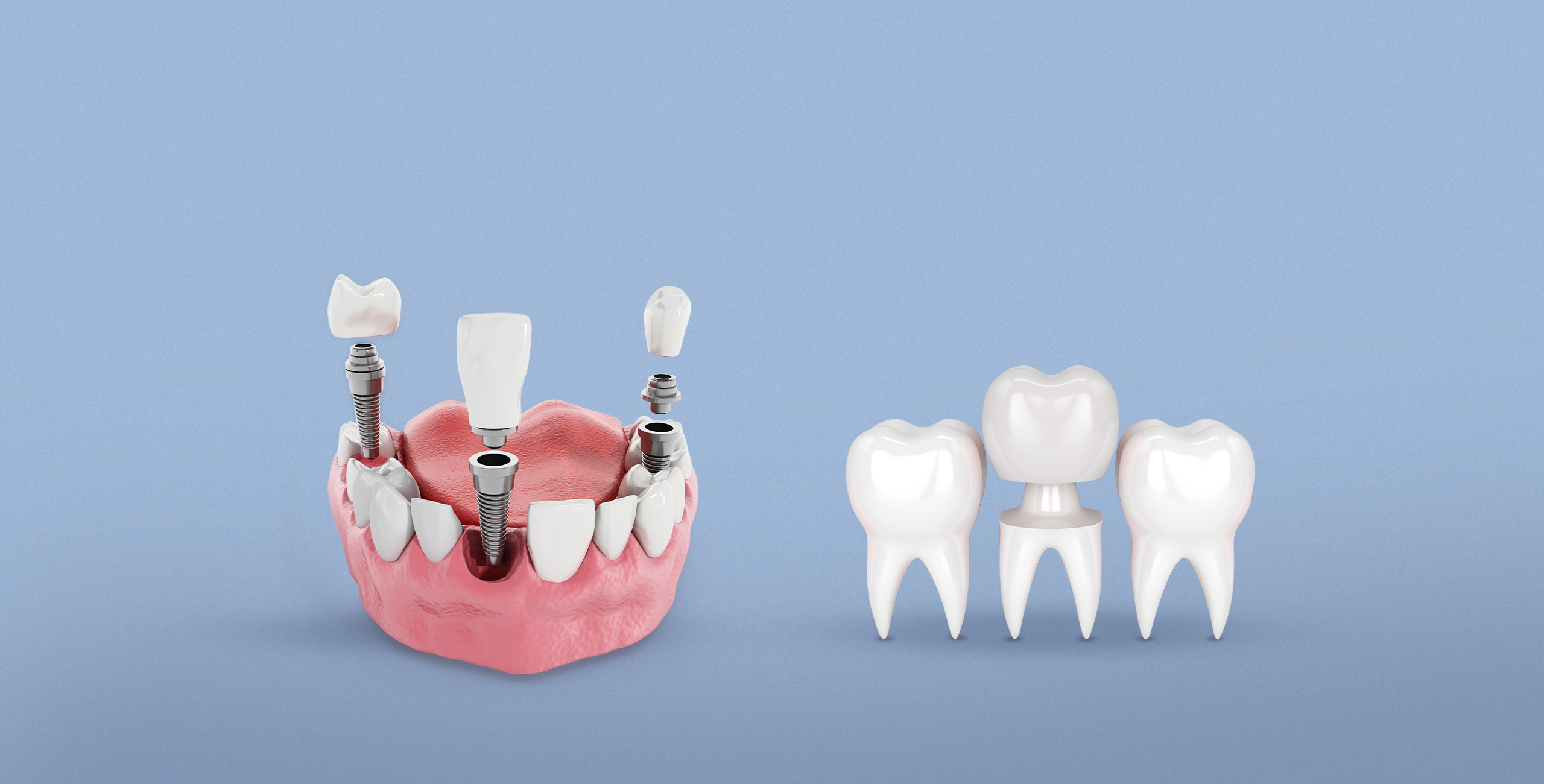 مميزات التركيبات للأسنان