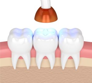 تعرف على تجميل الاسنان بالحشوات التجميليه وافضل مركز طبي لعلاج و تجميل الاسنان!