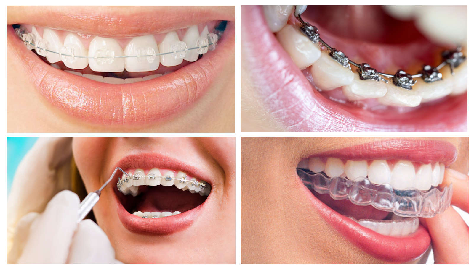 ما هي مدة تقويم الأسنان لسد الفراغات؟