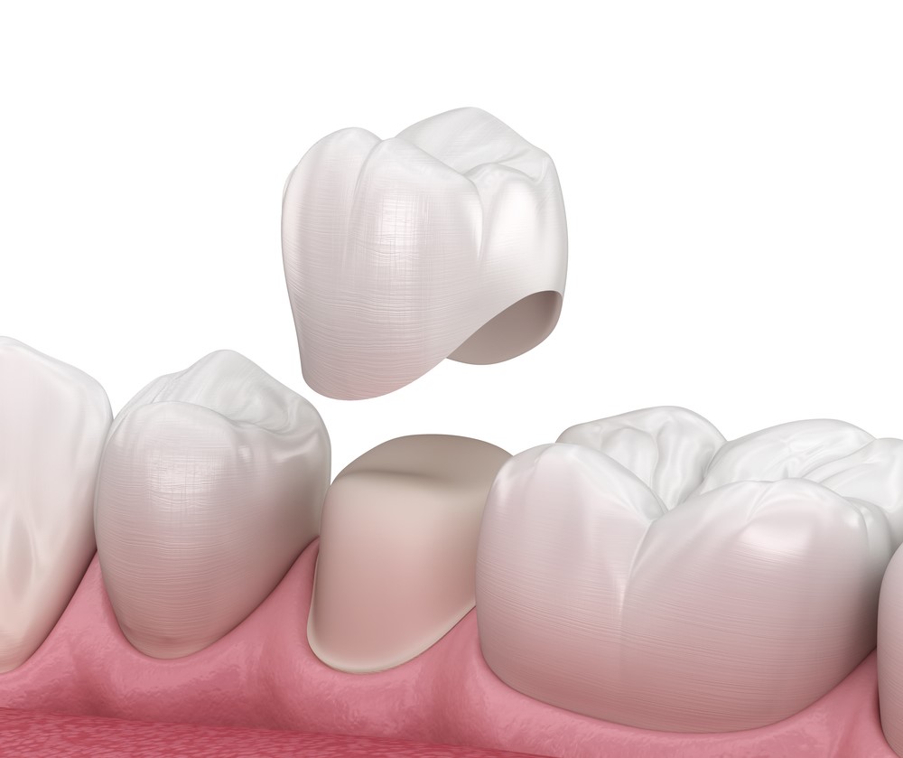 ما هي تركيبه اسنان مؤقته؟