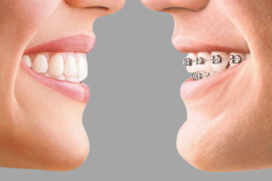 ما لا تعرفه عن تقويم الاسنان في مصر وهل يتغير شكل الفك بعد التركيب؟