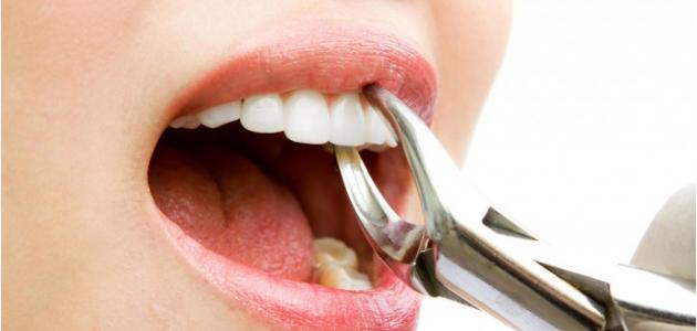 مسببات عيوب إطباق الأسنان