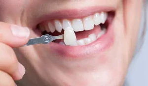 كيفية تركيب فينير الاسنان وما هو سعره في المركز الطبي لرعاية الأسنان؟