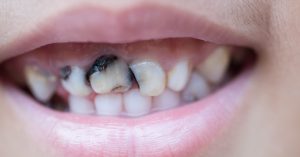 ما هو حشو الأسنان الأمامية المسوسة؟ وما المواد المستخدمة به؟