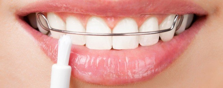 طريقة العناية بمثبت الأسنان الدائم