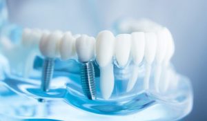 كيفية تركيب السن بعد الزراعة وما أفضل مركز لعلاج وتجميل الأسنان؟