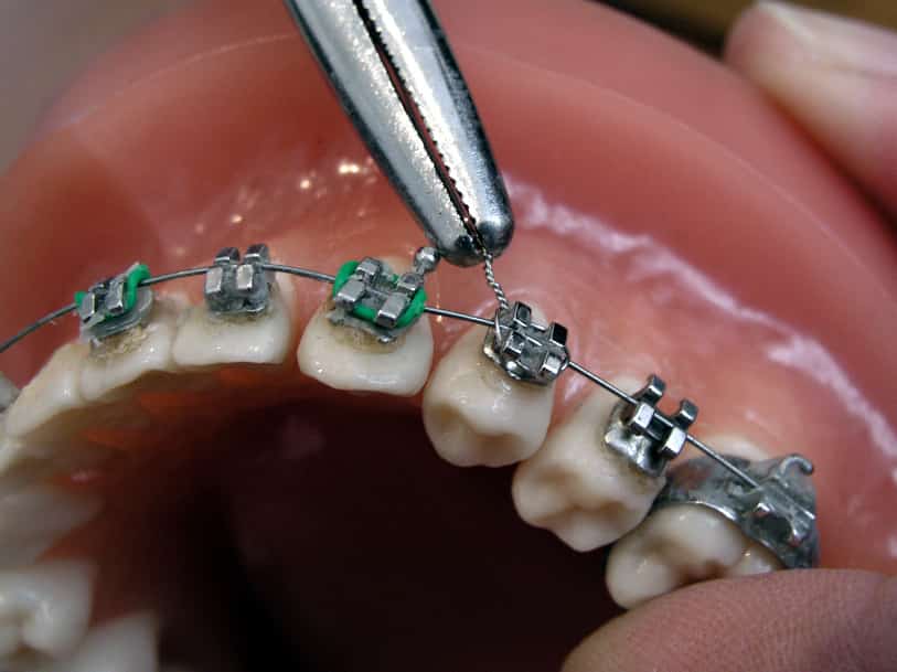 ما هي خطوات تركيب تقويم الاسنان ؟