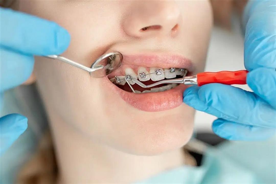ما هي خطوات تركيب تقويم الاسنان؟