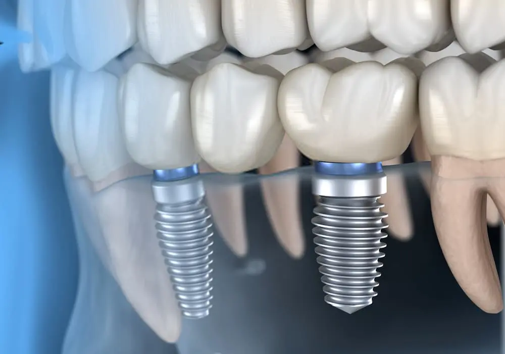 What is Immediate Dental Implantation?