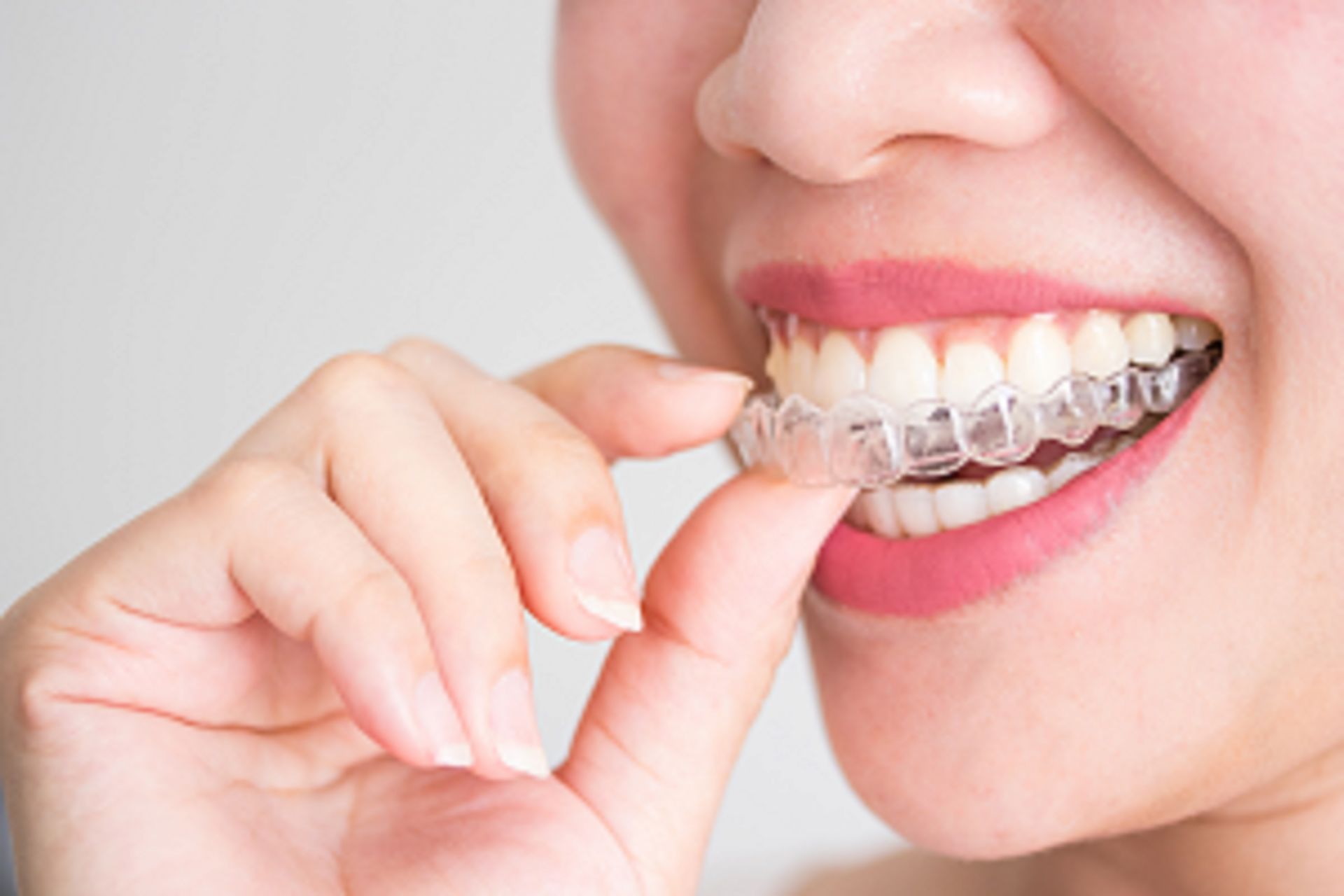 كيفية تركيب تقويم الأسنان الشفاف