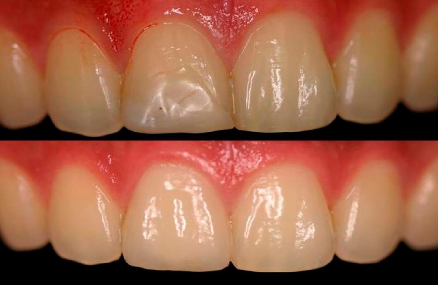 ماهي أنواع حشو الأسنان الأمامية ؟