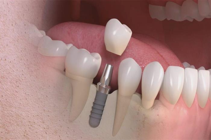 كم نسبة نجاح زراعة الاسنان؟