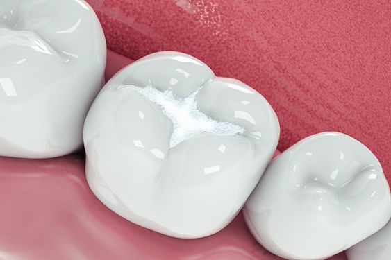 علامات تشير إلى ضرورة استبدال حشوة الأسنان