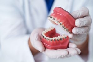 أشهر مراحل تركيب التقويم واكتشف كيف يمكن تجنب أضراره على الأسنان؟
