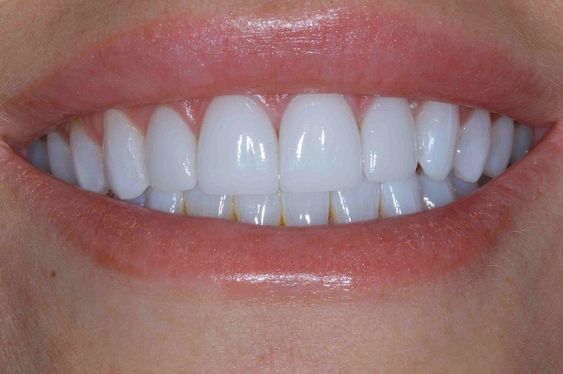 انواع فينير الاسنان