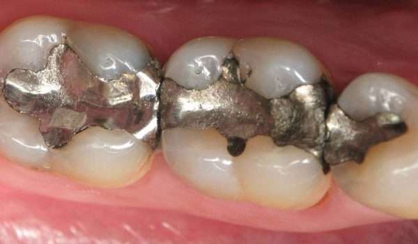 كم مدة بقاء حشوة الاسنان؟