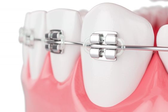 ما هي المدة التي يستغرقها تقويم الاسنان؟