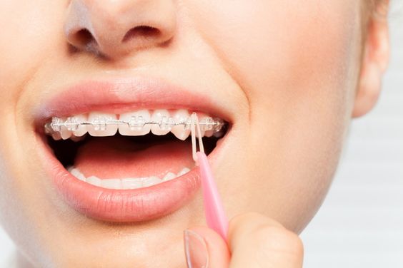 ما هي عيوب تقويم الأسنان ؟