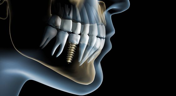 مميزات زراعة الأسنان في المركز الطبي لرعاية الاسنان