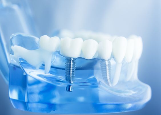 زراعة الأسنان في خمس دقائق وأفضل مركز لعلاج وتجميل الأسنان