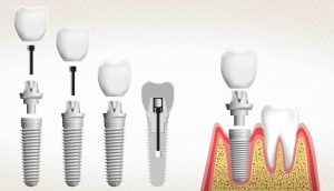 ما هي عملية زراعة الاسنان كاملة ومن هو المرشح الأمثل لها؟