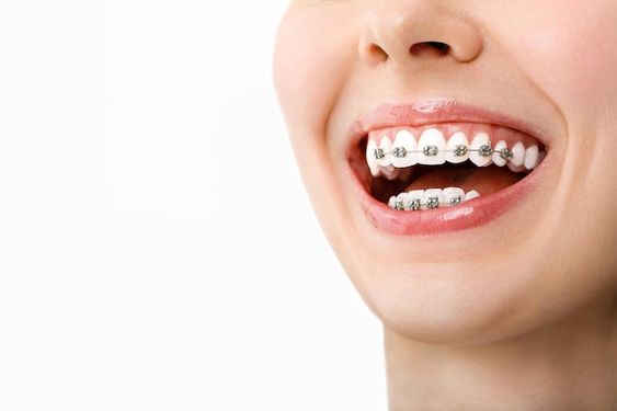 أهمية تقويم الأسنان