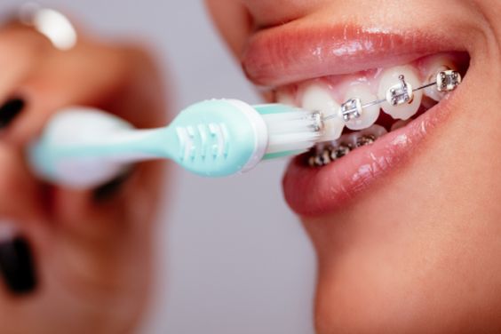 كيفيه تركيب تقويم الاسنان