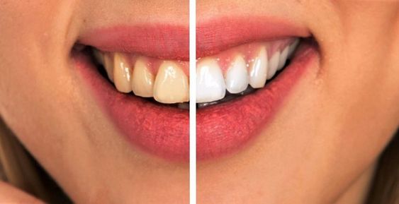 هل يمكن تبييض تركيبات الأسنان؟
