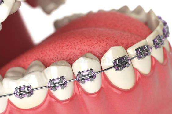 متى تبدأ نتائج تقويم الاسنان في الظهور؟