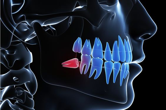 الحالات المرشحة لزراعة الأسنان