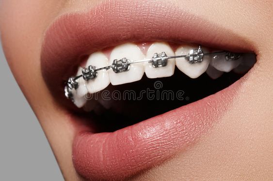 ما هي فوائد تقويم الأسنان؟