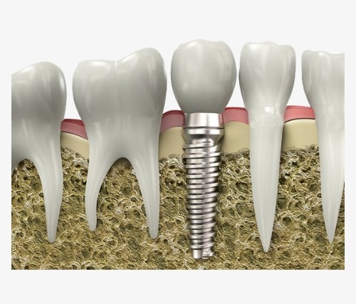 ما الأعراض التي تتوقع الشعور بها بعد زراعة الأسنان ؟