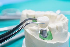 ما هي زراعة الأسنان في جلسة واحدة وطريقة القيام بها؟