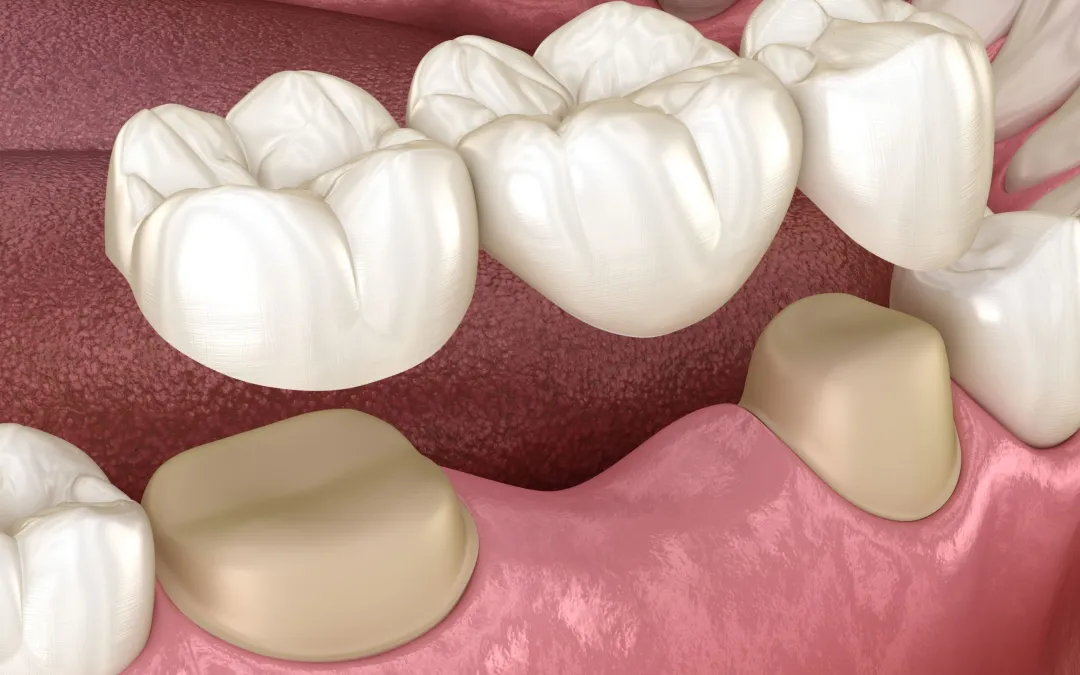 هل تركيب جسور الأسنان مؤلم؟