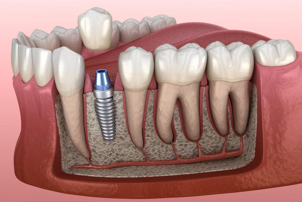 ما علامات فشل زراعة الأسنان؟