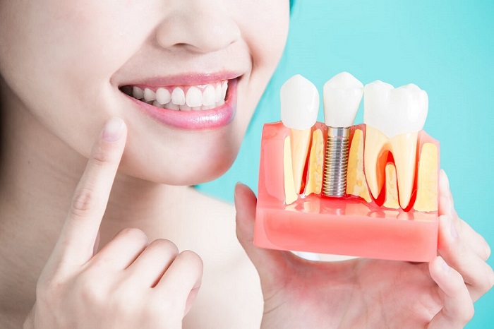 أبرز الاختلافات بين زراعة الاسنان الفورية وزراعة الاسنان التقليدية
