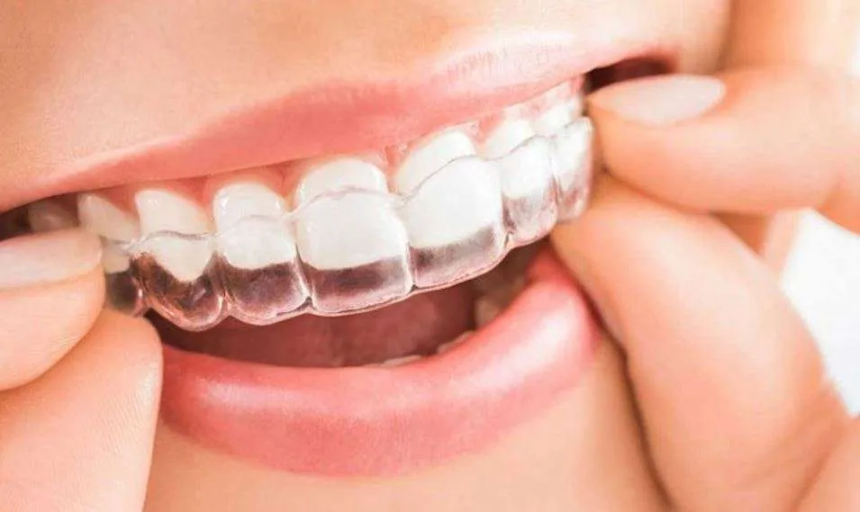 ما المدة التي يستغرقها تقويم الانفزلاين في الأسنان؟
