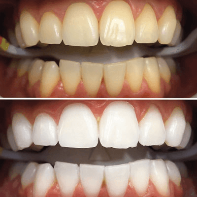 أضرار تلميع الاسنان